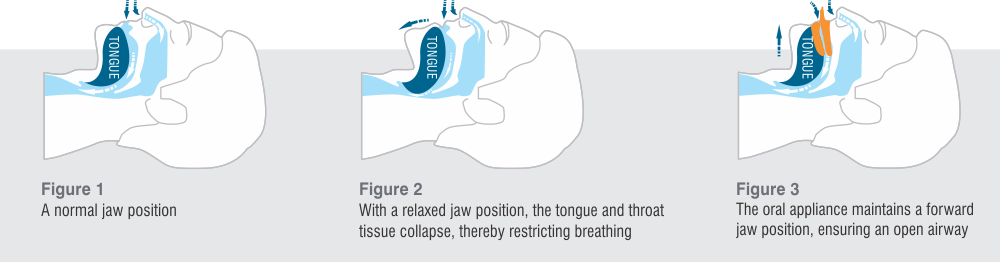 Mandibular Advancement Devices Mandibular Advancement Devices